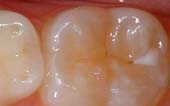 Sealant-Before - Pediatric Dentist in Janesville, WI